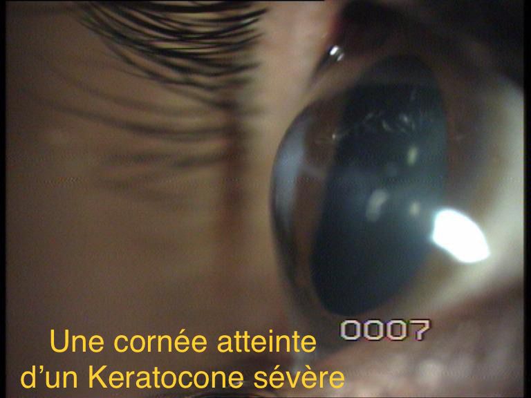 traitement-keratocone